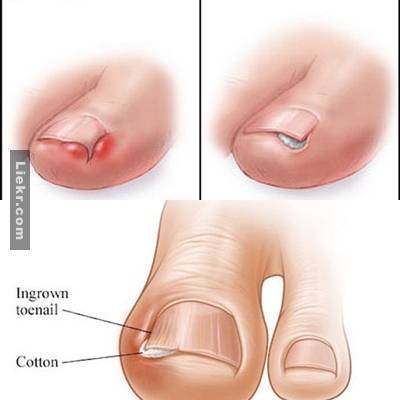 เล็บขบ คืออะไร? (Ingrown Toenail)