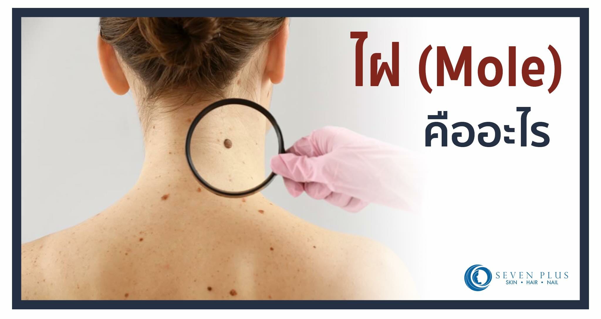 ไฝ (Mole) คืออะไร?