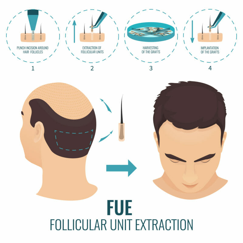 Follicular unit extraction คือ