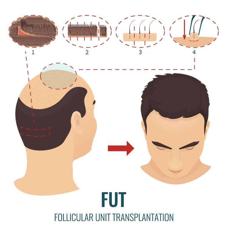 Follicular unit transplation คือ