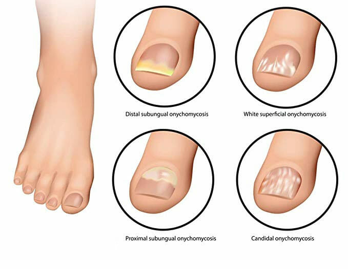 onychomycosis