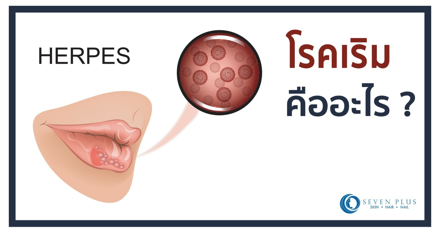 โรคเริม