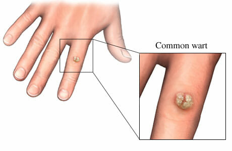 Warts