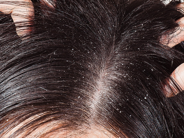 dandruff