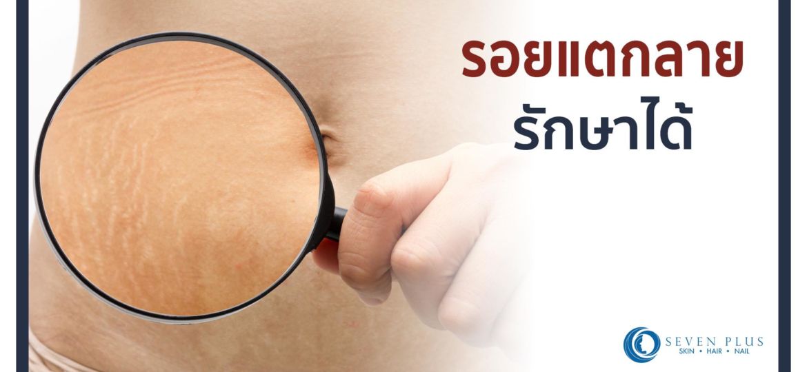 can stretch marks be cured