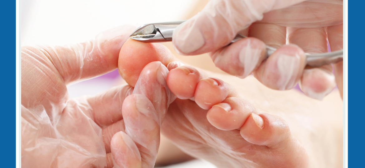 Ingrown toenail