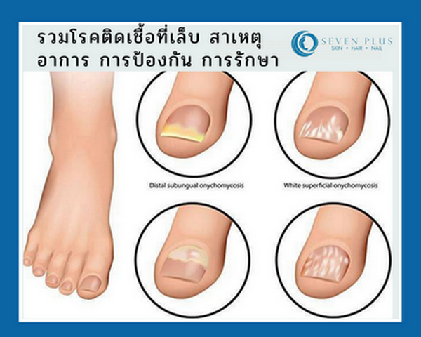 เชื้อราที่เท้า pantip