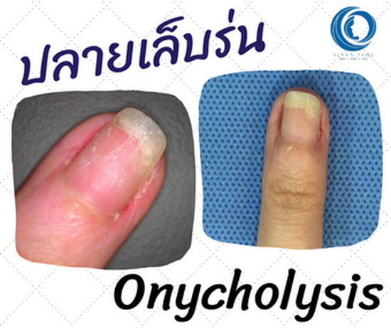 Onycholysis ปลายเล็บร่น