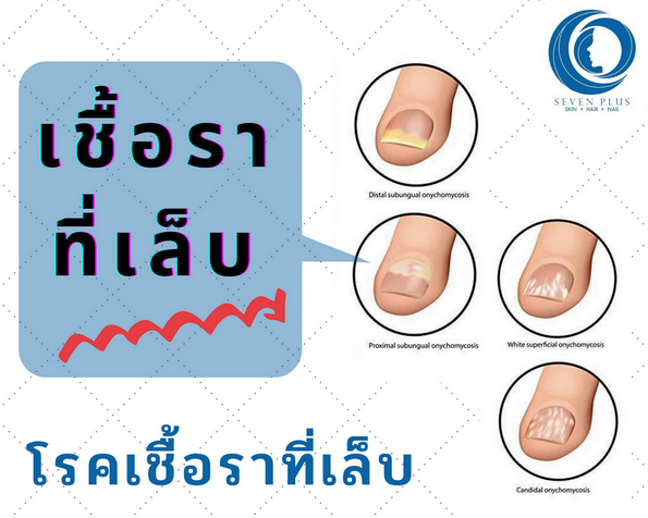 รวมความรู้ โรคเชื้อราที่เล็บ อ่านแล้ว เข้าใจเคลียร์!